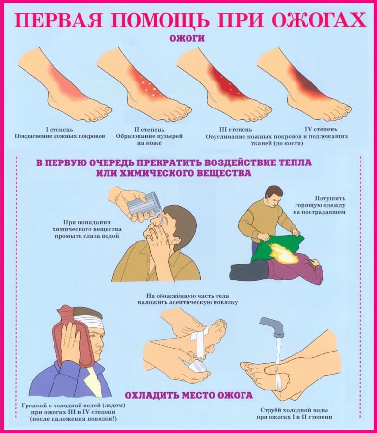 Первая медицинская помощь при ожогах и электро травмах на отдыхе и дома